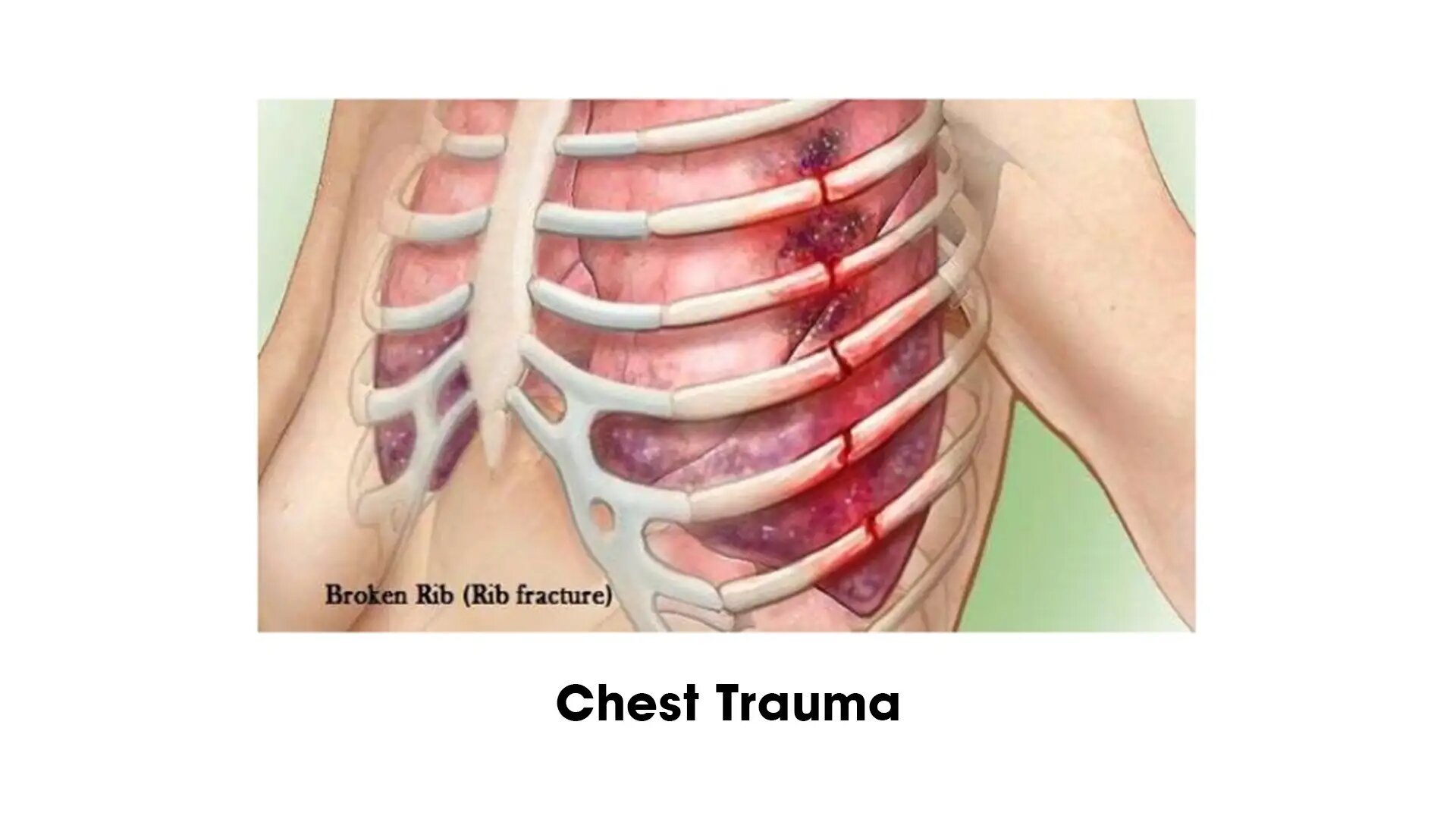 Chest Trauma Treatment In Delhi